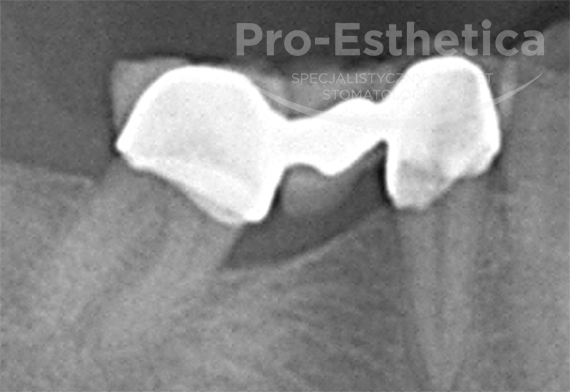 implanty-dentystyczne-warszawa-06a