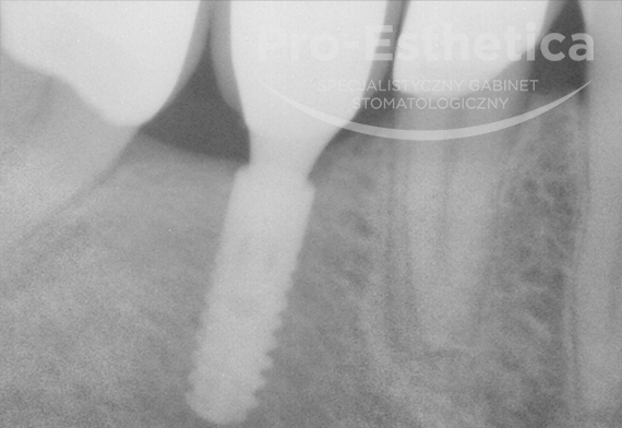 implanty-dentystyczne-warszawa-06d